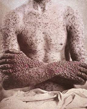 Man with smallpox